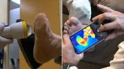 World-first AI camera aims to prevent diabetic amputations